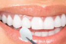 Mitos e verdades sobre a lente de contato dental